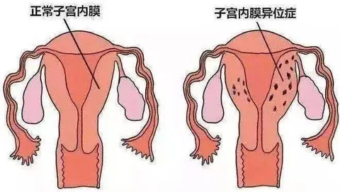 子宫内膜异位症女性的阴道菌群：一次&ldquo;质变&rdquo;而非&ldquo;量变&rdquo;
